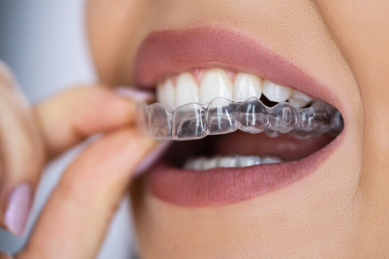 What Are Spark Aligners and How Do They Work? - Dental Blog - Cannon ...